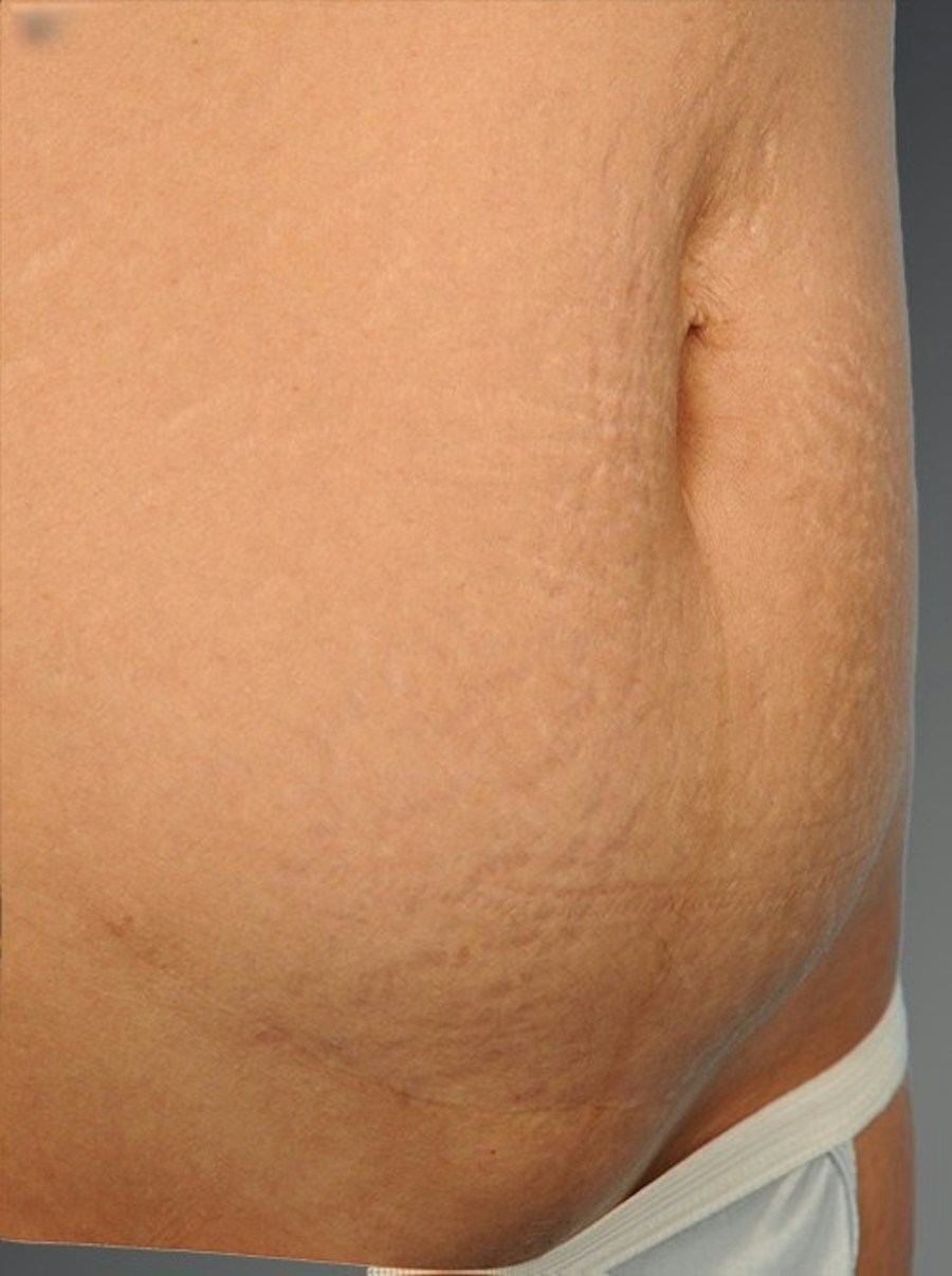 Patient 114188442 | Angle View | After — Steven Teitelbaum MD -