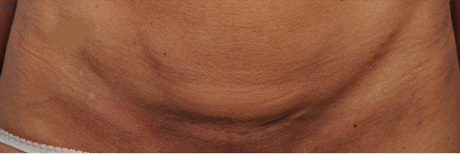 Patient 114188447 | Front View | Before — Steven Teitelbaum MD -