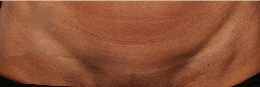 Patient 114188447 | Front View | After — Steven Teitelbaum MD -