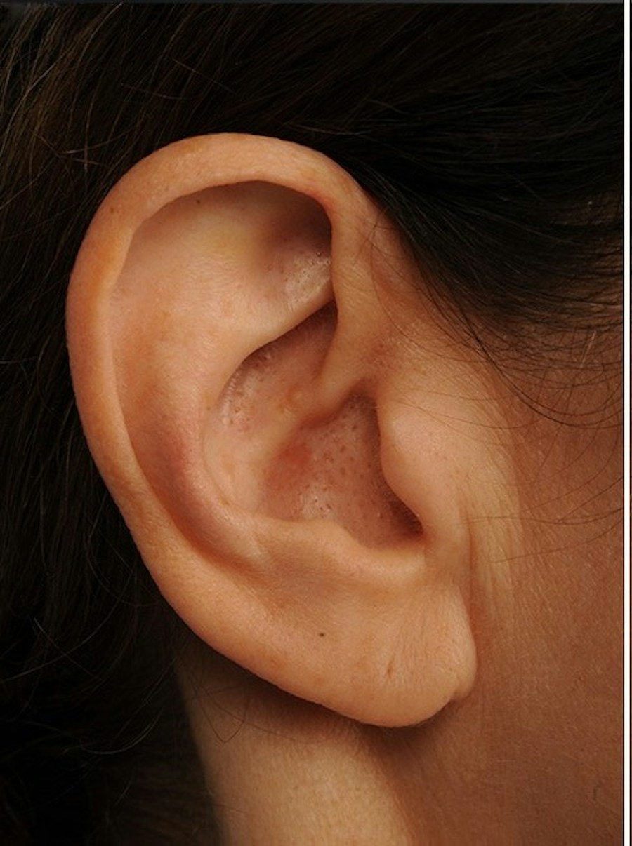 Patient 138104 | Profile View | Before — Steven Teitelbaum MD -
