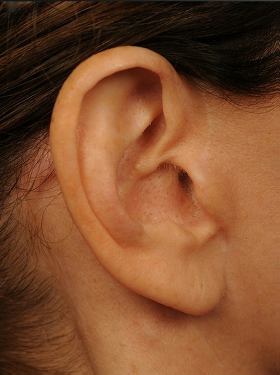Patient 138104 | Profile View | After — Steven Teitelbaum MD -