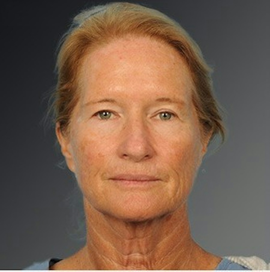 Patient 108676468 | Front View | Before | Face and Neck Lift — Steven Teitelbaum MD -