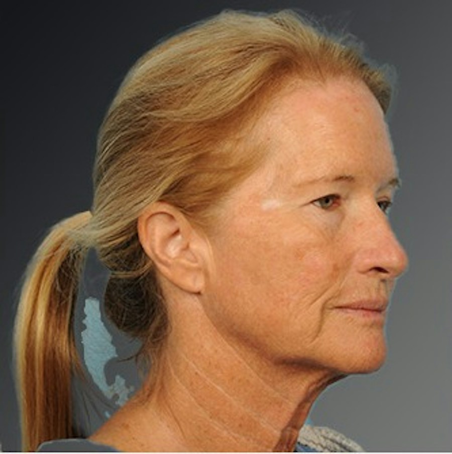 Patient 108676468 | Angle View | Before | Face and Neck Lift — Steven Teitelbaum MD -
