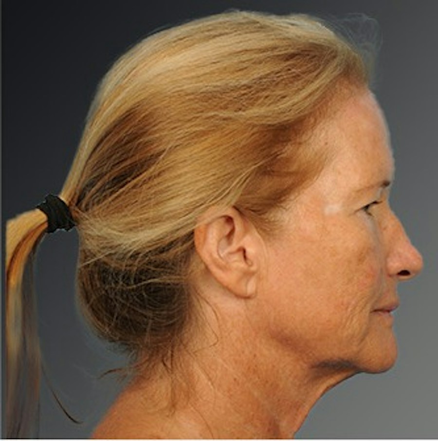 Patient 108676468 | Profile View | Before | Face and Neck Lift — Steven Teitelbaum MD -