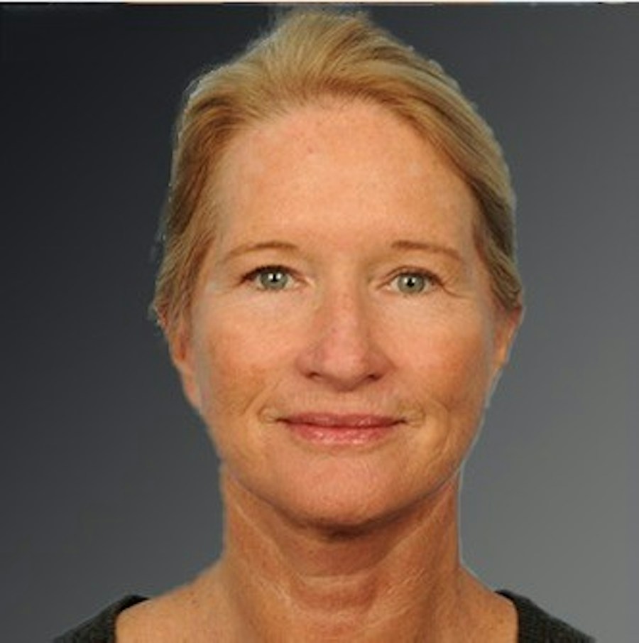 Patient 108676468 | Front View | After | Face and Neck Lift — Steven Teitelbaum MD - Santa Monica