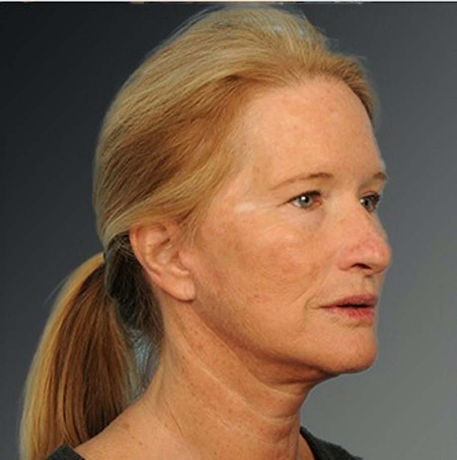 Patient 108676468 | Angle View | After | Face and Neck Lift — Steven Teitelbaum MD -