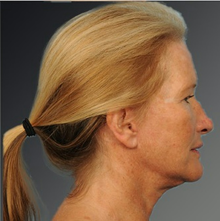 Patient 108676468 | Profile View | After | Face and Neck Lift — Steven Teitelbaum MD -