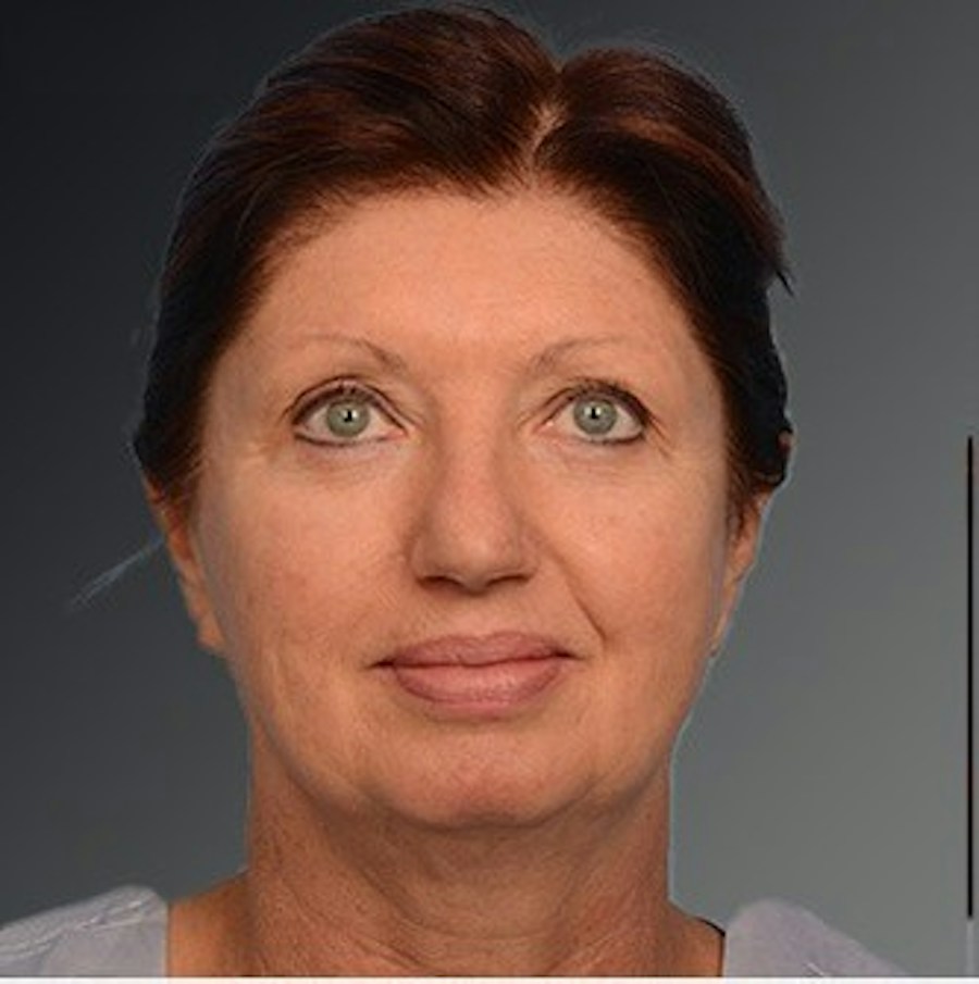 Patient 106009204 | Front View | Before | Face and Neck Lift — Steven Teitelbaum MD -