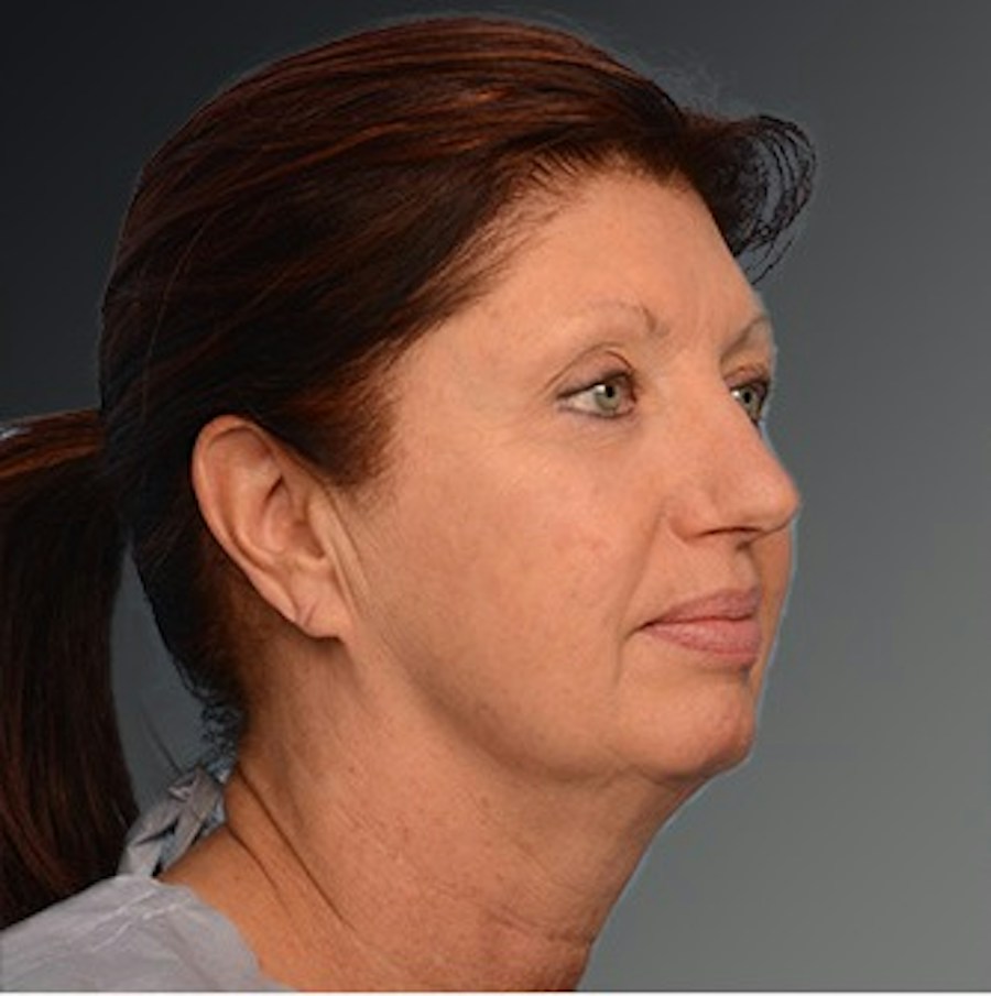 Patient 106009204 | Angle View | Before | Face and Neck Lift — Steven Teitelbaum MD -