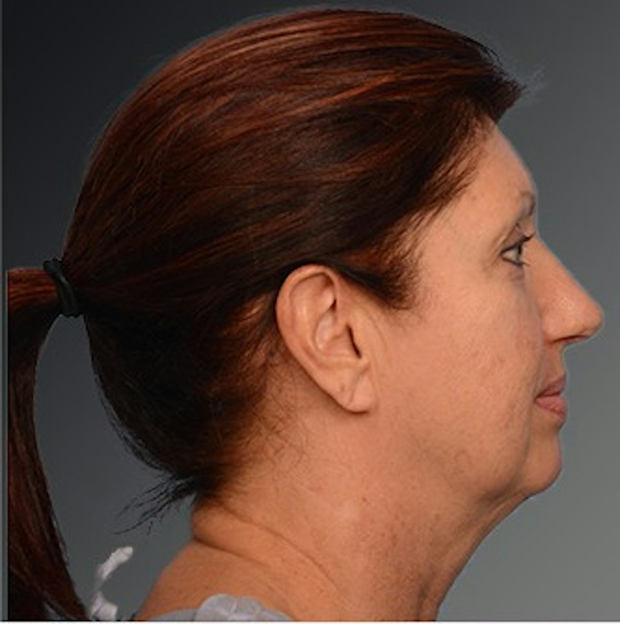 Patient 106009204 | Profile View | Before | Face and Neck Lift — Steven Teitelbaum MD -