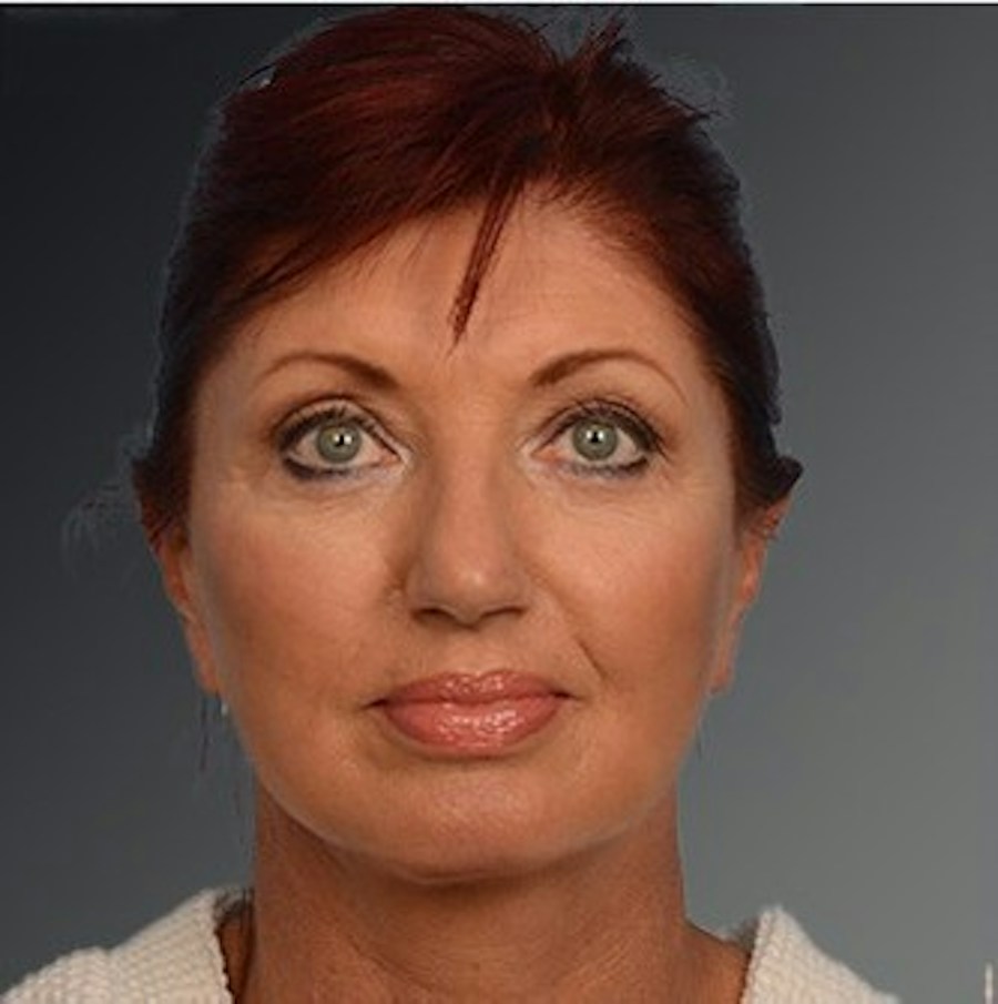 Patient 106009204 | Front View | After | Face and Neck Lift — Steven Teitelbaum MD - Santa Monica