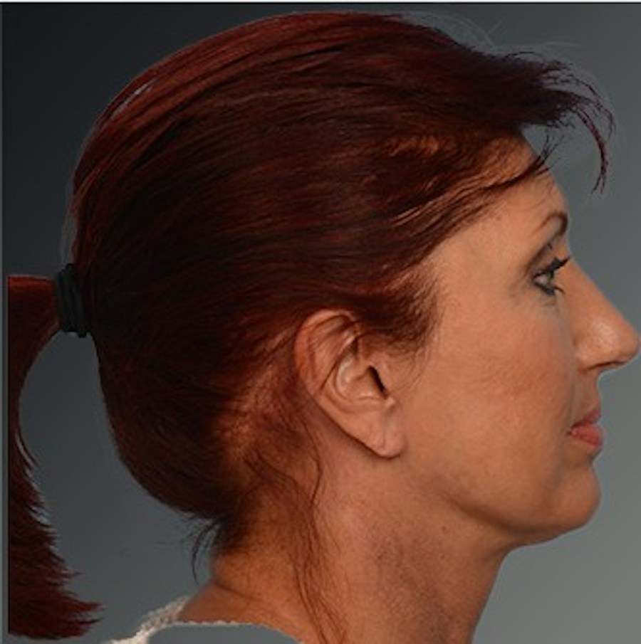 Patient 106009204 | Profile View | After | Face and Neck Lift — Steven Teitelbaum MD -