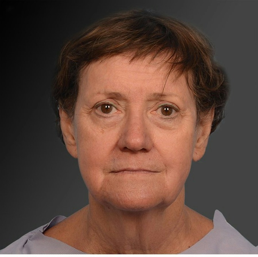 Patient 106009206 | Front View | Before | Face and Neck Lift — Steven Teitelbaum MD -