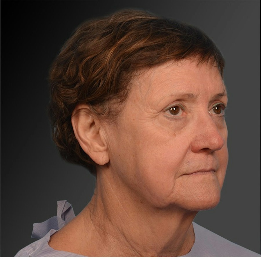 Patient 106009206 | Angle View | Before | Face and Neck Lift — Steven Teitelbaum MD -