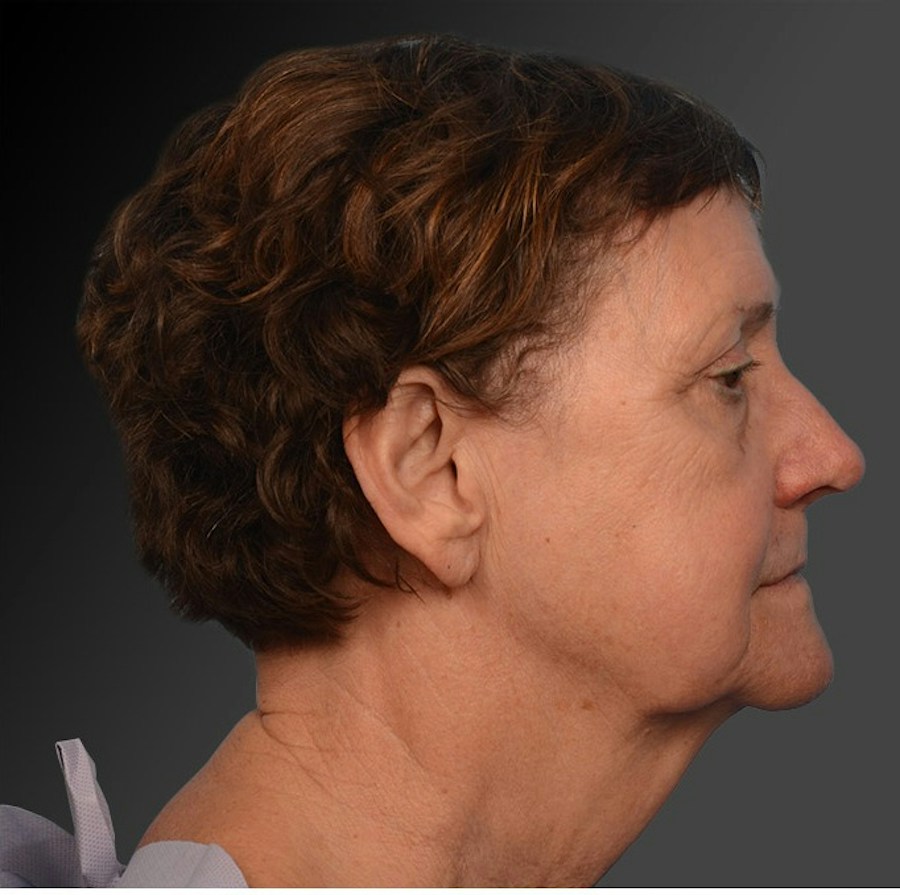 Patient 106009206 | Profile View | Before | Face and Neck Lift — Steven Teitelbaum MD -