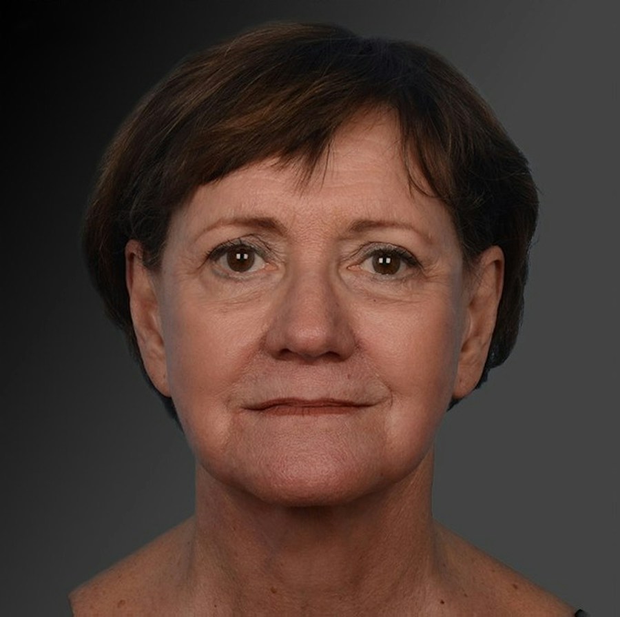 Patient 106009206 | Front View | After | Face and Neck Lift — Steven Teitelbaum MD -