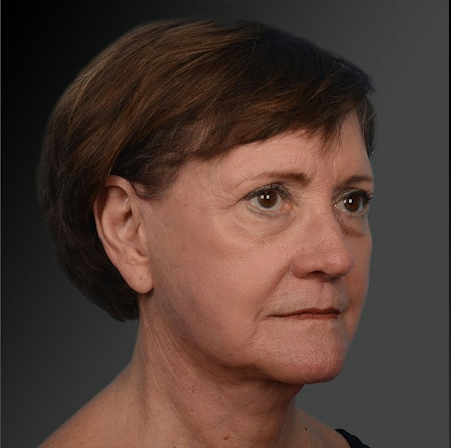 Patient 106009206 | Angle View | After | Face and Neck Lift — Steven Teitelbaum MD -