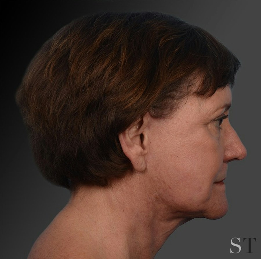 Patient 106009206 | Profile View | After | Face and Neck Lift — Steven Teitelbaum MD -