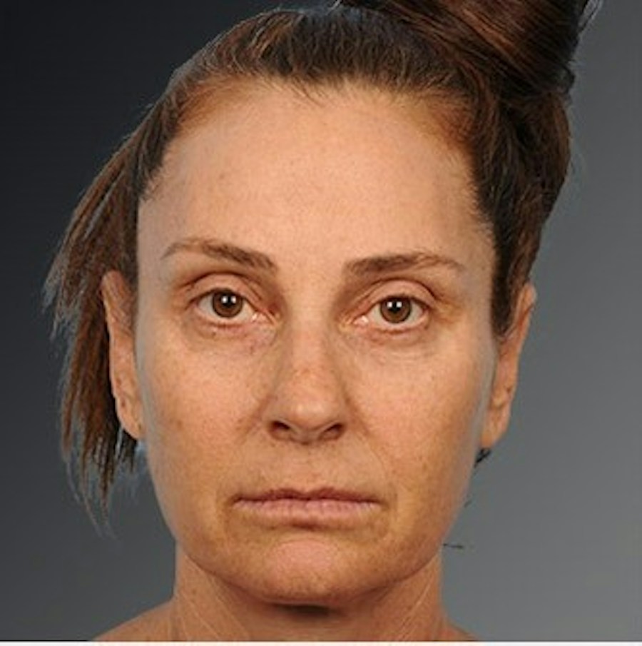 Patient 106009207 | Front View | Before | Face and Neck Lift — Steven Teitelbaum MD -