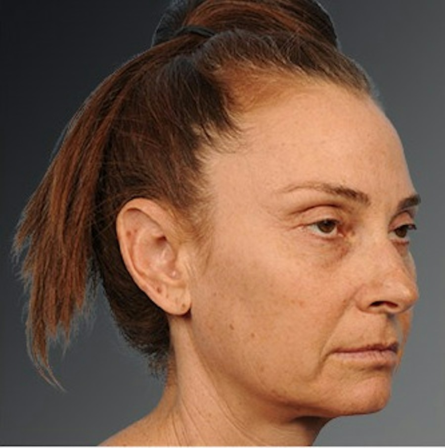 Patient 106009207 | Angle View | Before | Face and Neck Lift — Steven Teitelbaum MD -
