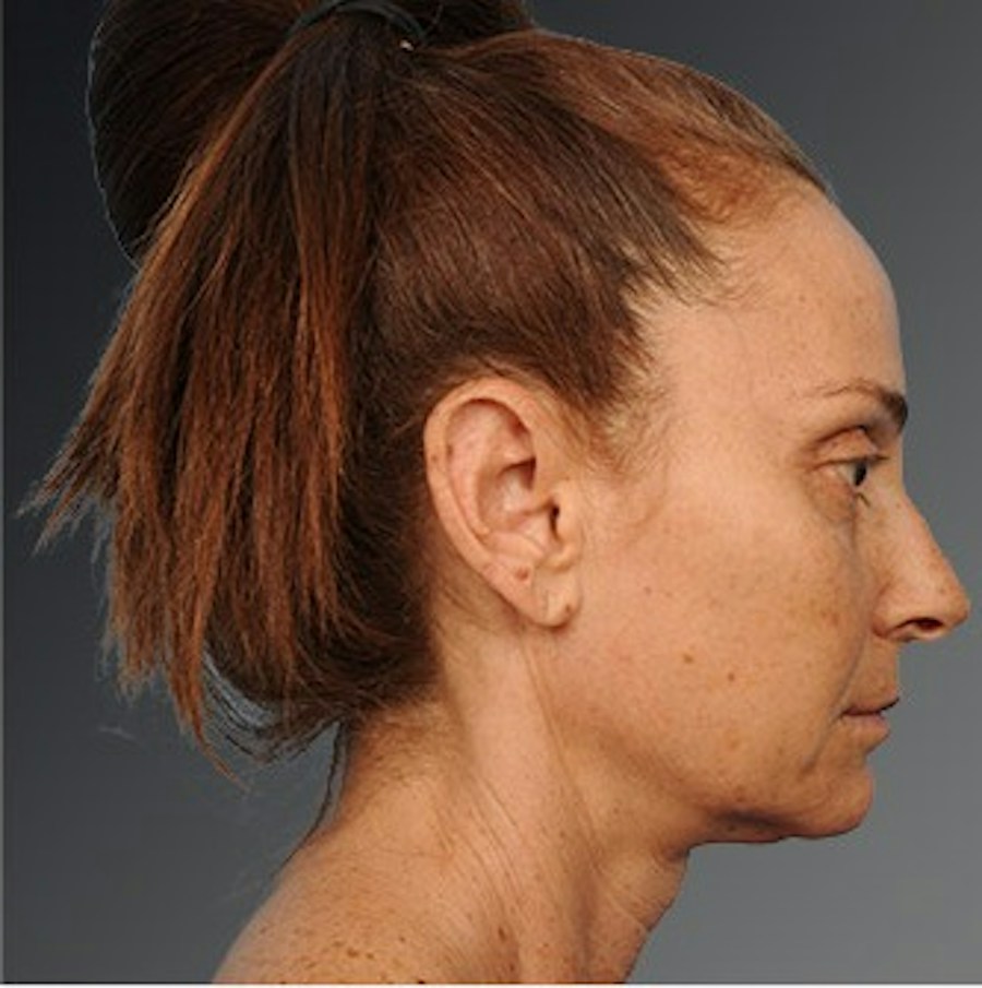 Patient 106009207 | Profile View | Before | Face and Neck Lift — Steven Teitelbaum MD -