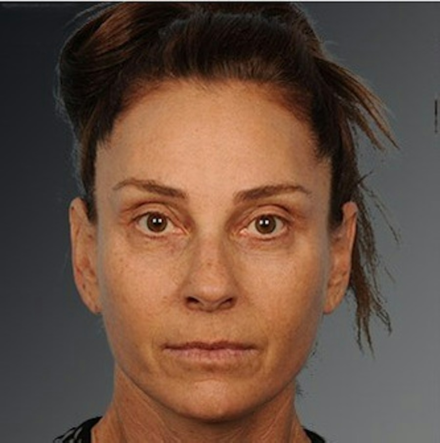 Patient 106009207 | Front View | After | Face and Neck Lift — Steven Teitelbaum MD -