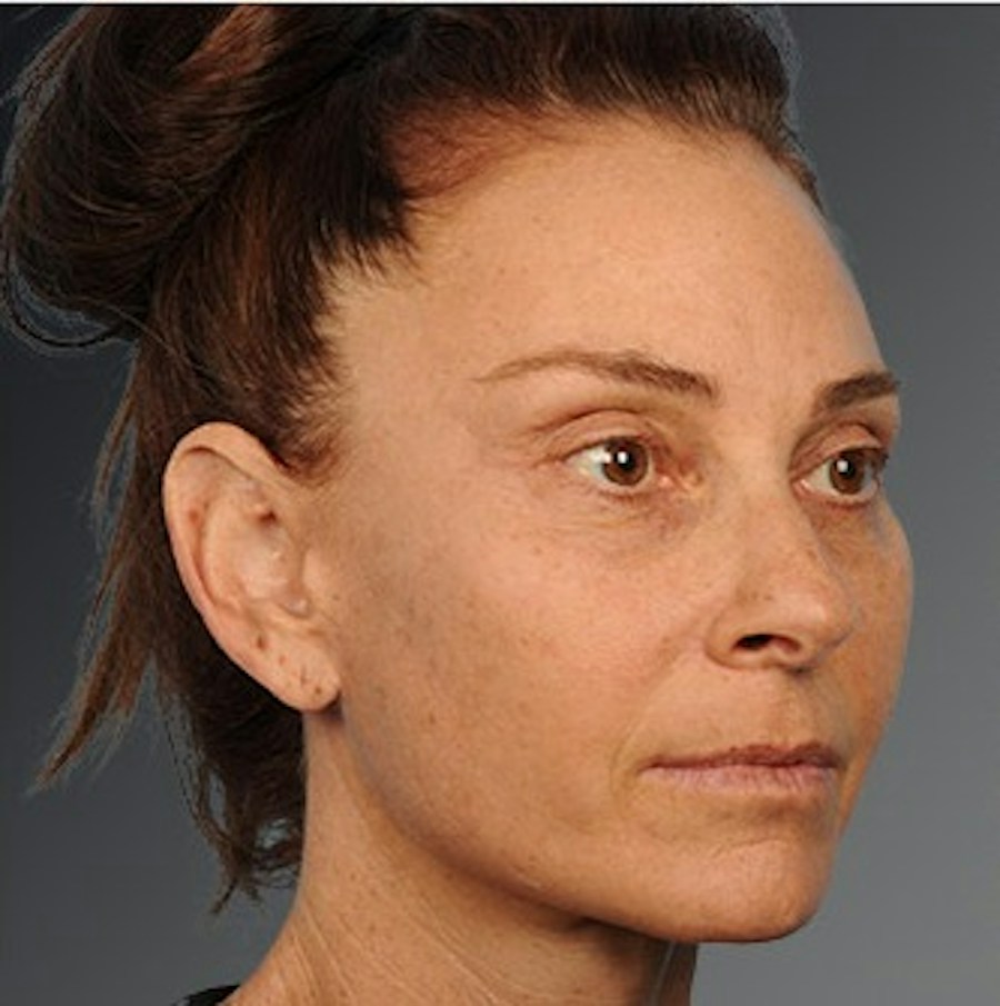 Patient 106009207 | Angle View | After | Face and Neck Lift — Steven Teitelbaum MD -