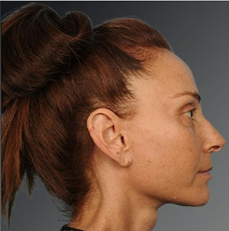 Patient 106009207 | Profile View | After | Face and Neck Lift — Steven Teitelbaum MD -
