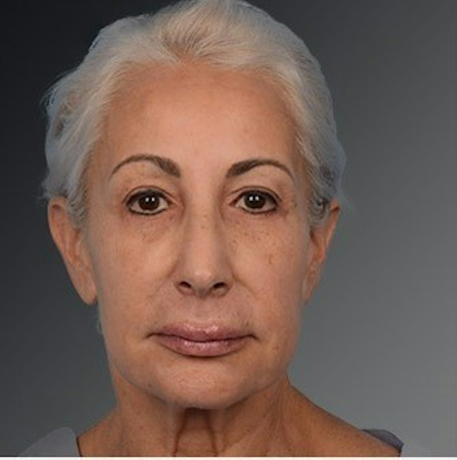 Patient 106009208 | Front View | Before | Face and Neck Lift — Steven Teitelbaum MD -