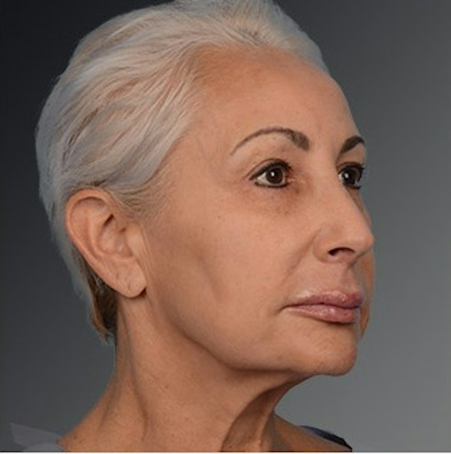 Patient 106009208 | Angle View | Before | Face and Neck Lift — Steven Teitelbaum MD -