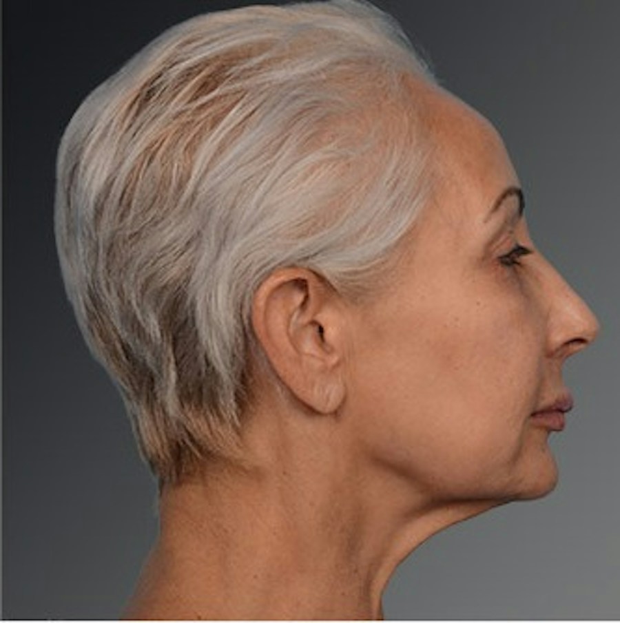 Patient 106009208 | Profile View | Before | Face and Neck Lift — Steven Teitelbaum MD -