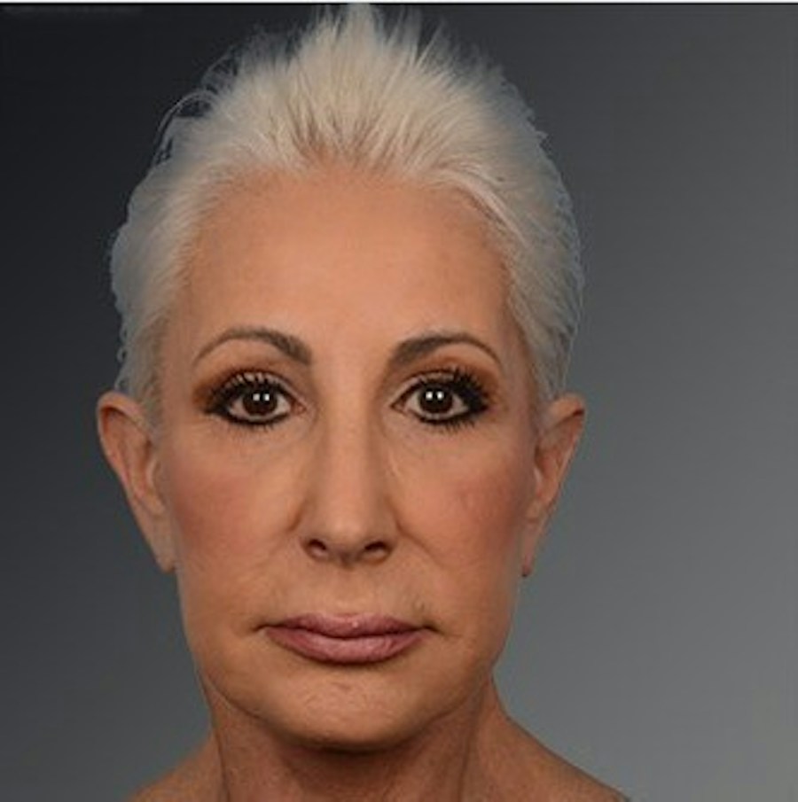 Patient 106009208 | Front View | After | Face and Neck Lift — Steven Teitelbaum MD - Santa Monica