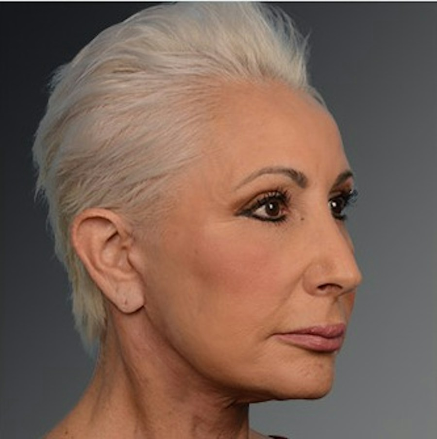 Patient 106009208 | Angle View | After | Face and Neck Lift — Steven Teitelbaum MD -