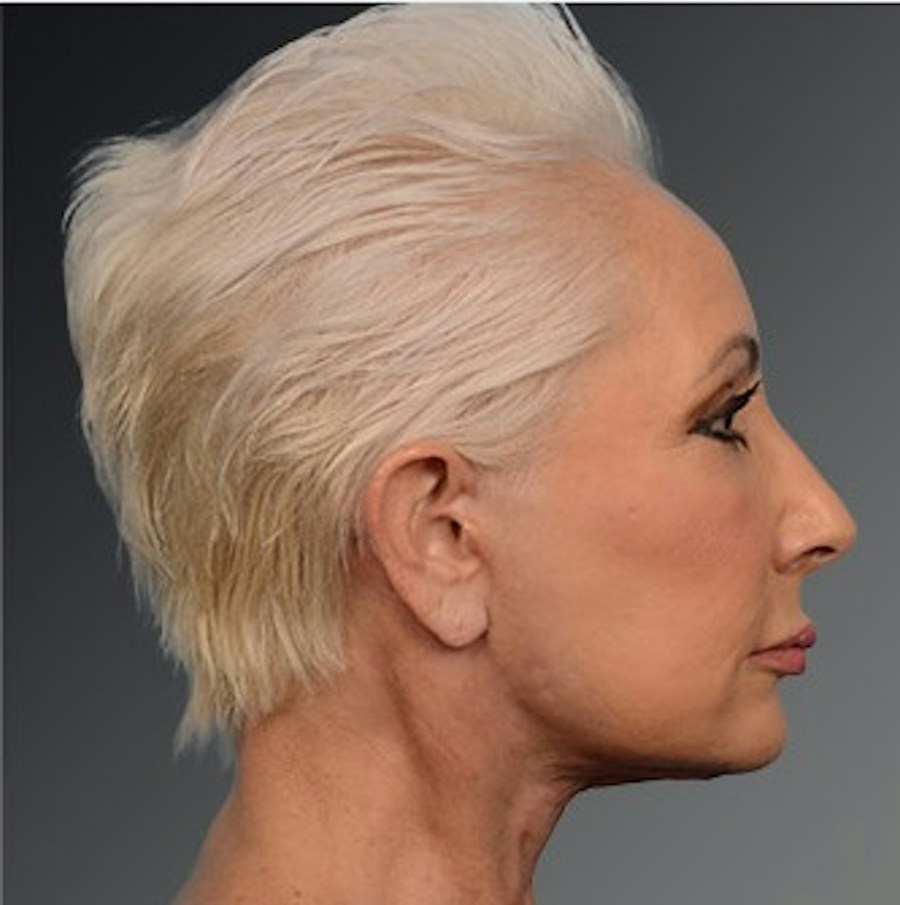 Patient 106009208 | Profile View | After | Face and Neck Lift — Steven Teitelbaum MD -