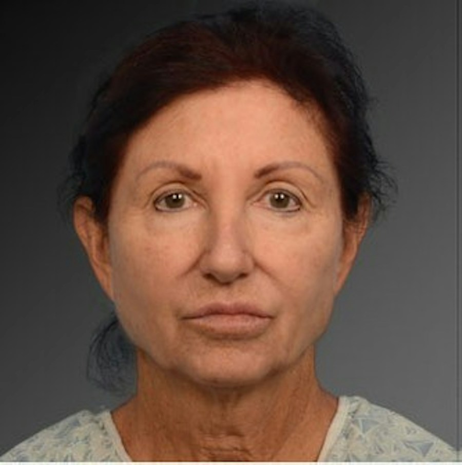 Patient 106009211 | Front View | Before | Face and Neck Lift — Steven Teitelbaum MD -