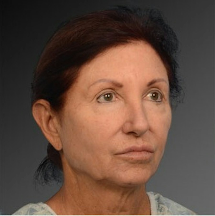 Patient 106009211 | Angle View | Before | Face and Neck Lift — Steven Teitelbaum MD -
