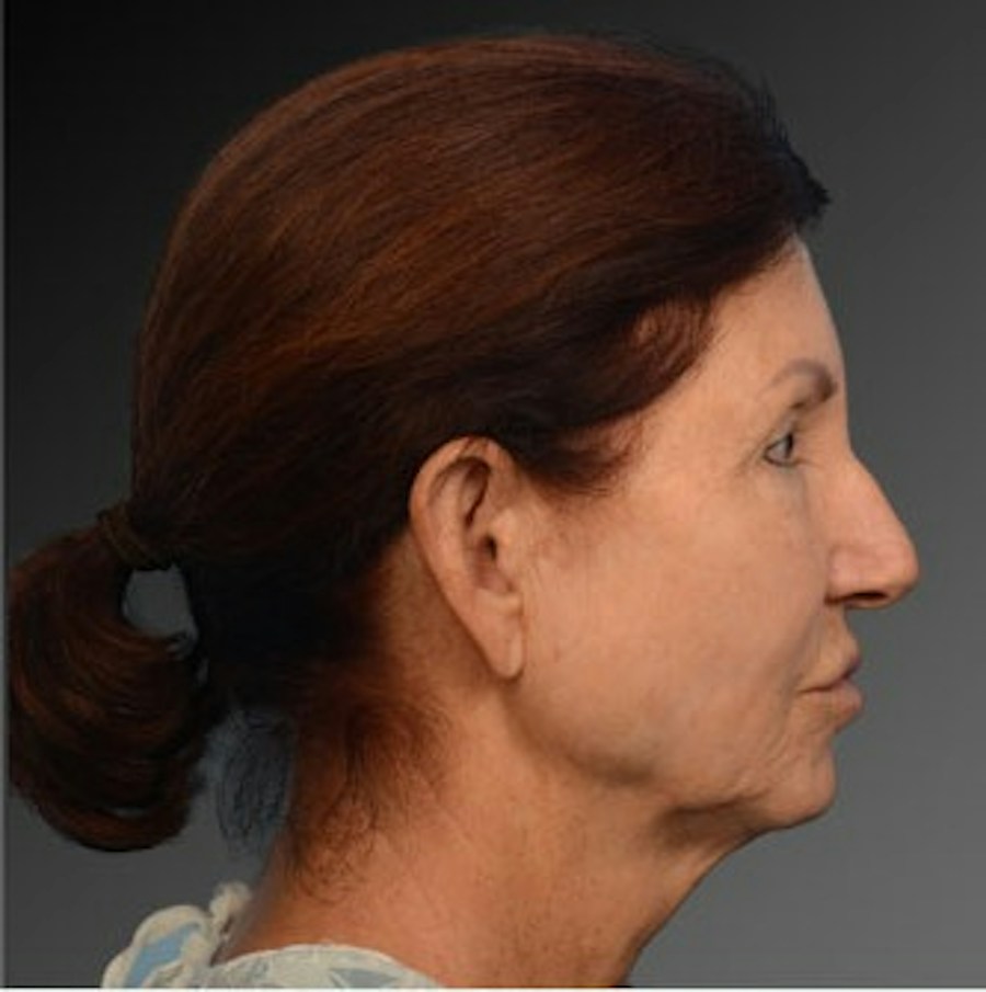Patient 106009211 | Profile View | Before | Face and Neck Lift — Steven Teitelbaum MD -