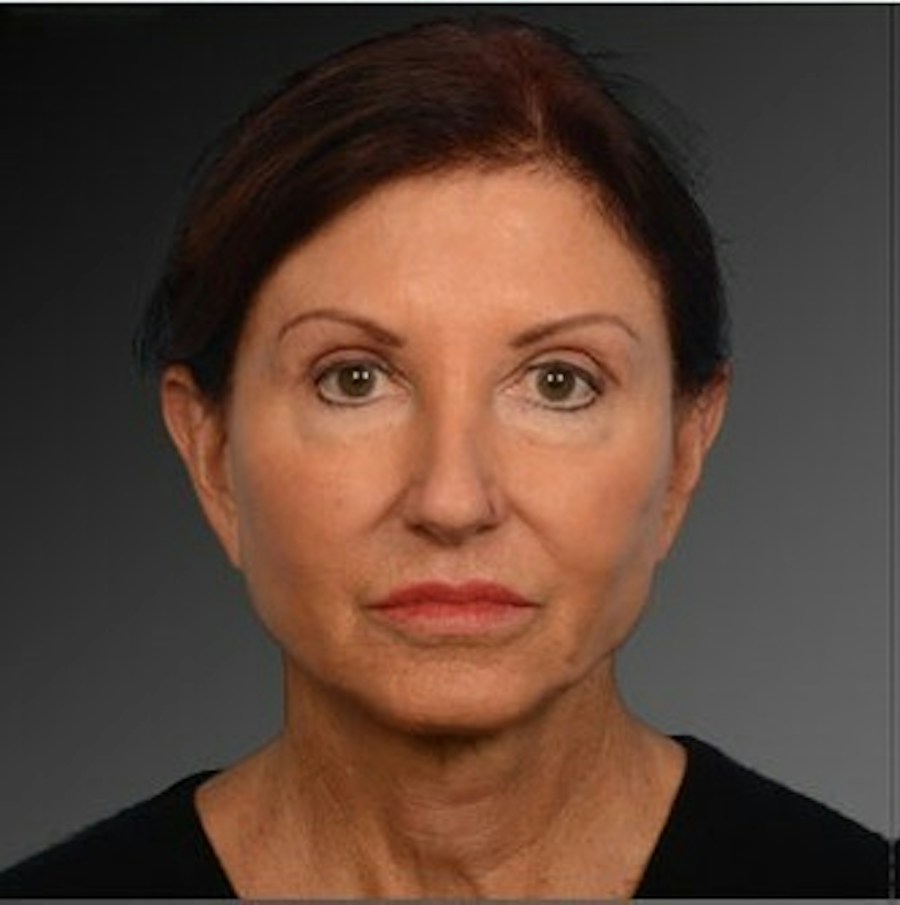 Patient 106009211 | Front View | After | Face and Neck Lift — Steven Teitelbaum MD -