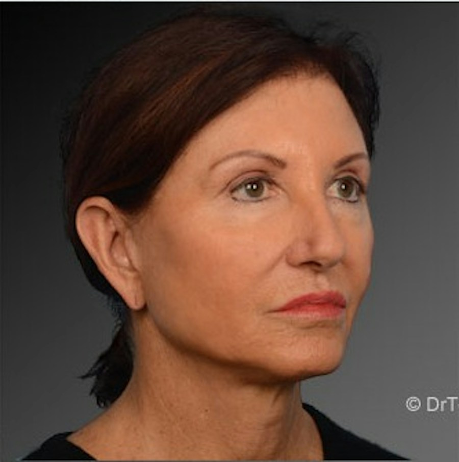Patient 106009211 | Angle View | After | Face and Neck Lift — Steven Teitelbaum MD -