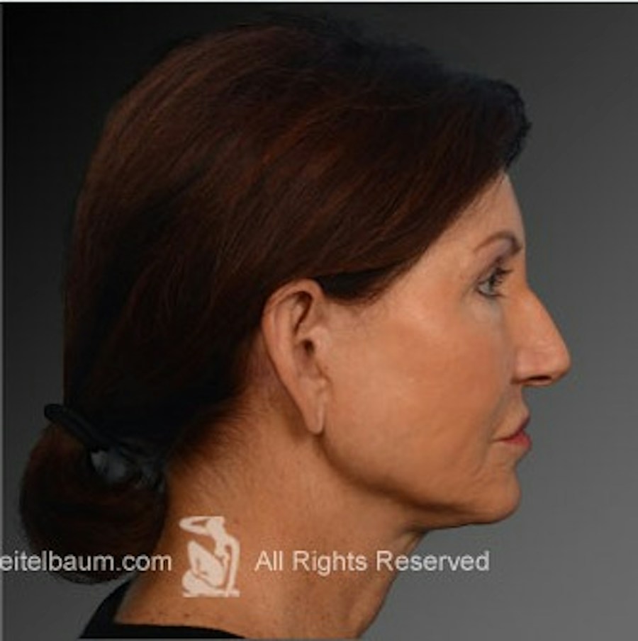 Patient 106009211 | Profile View | After | Face and Neck Lift — Steven Teitelbaum MD -
