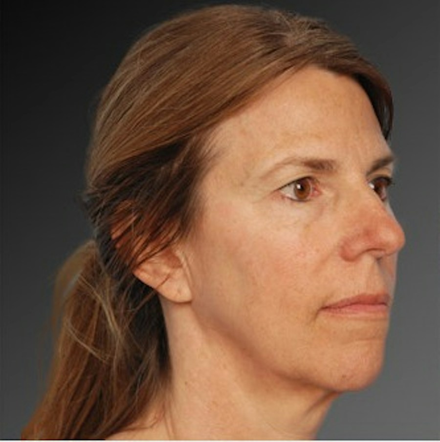 Patient 106009212 | Angle View | Before | Face and Neck Lift — Steven Teitelbaum MD -