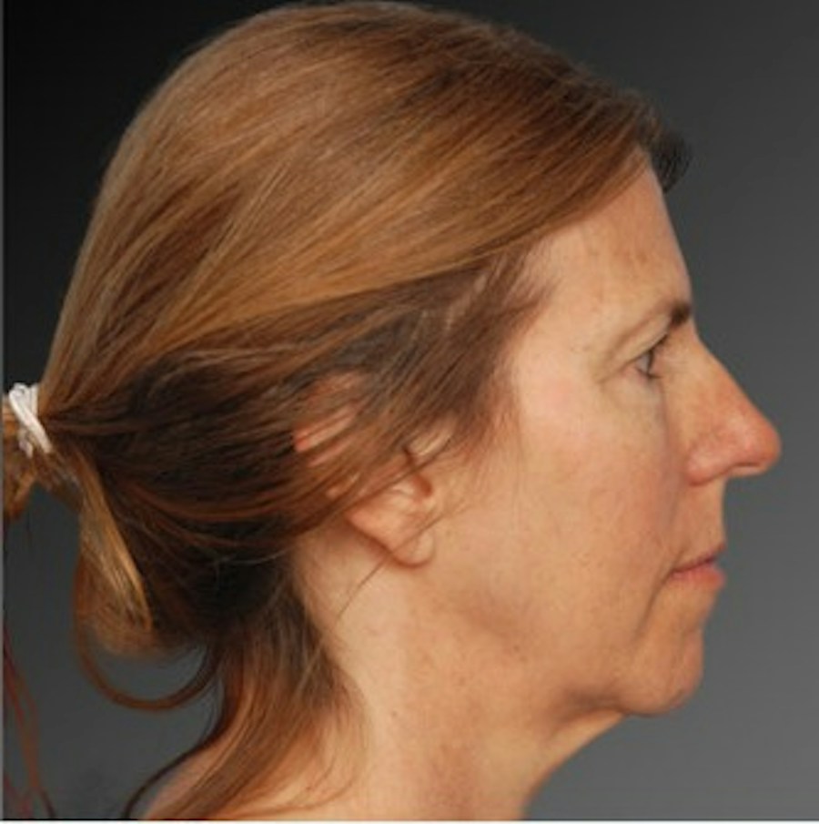 Patient 106009212 | Profile View | Before | Face and Neck Lift — Steven Teitelbaum MD -