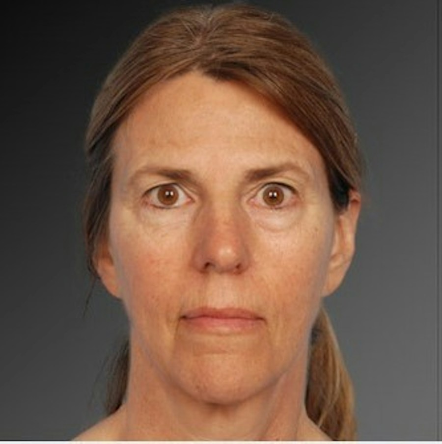 Patient 106009212 | Front View | Before | Face and Neck Lift — Steven Teitelbaum MD -