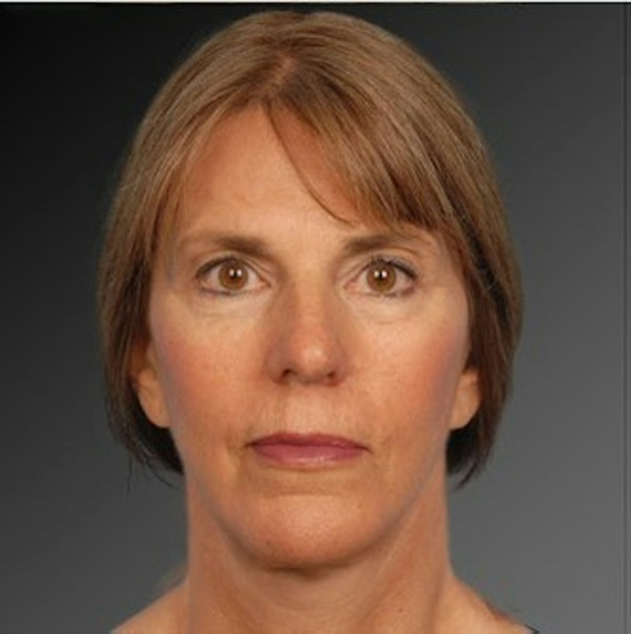 Patient 106009212 | Front View | After | Face and Neck Lift — Steven Teitelbaum MD -