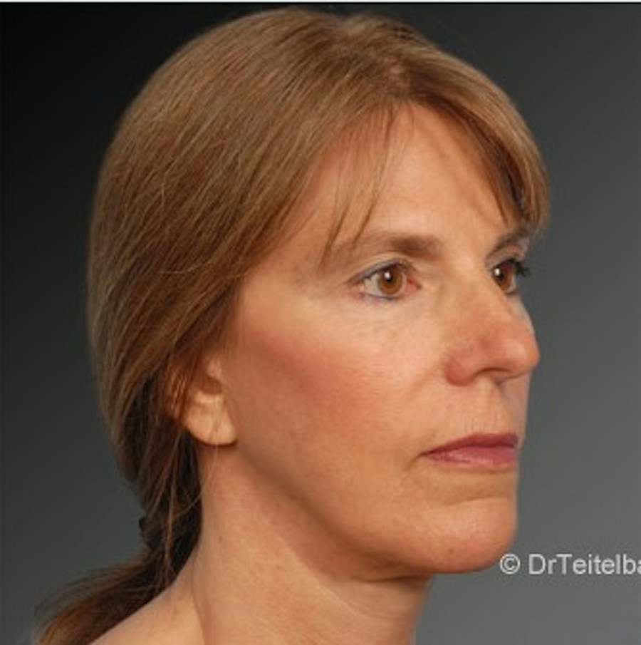 Patient 106009212 | Angle View | After | Face and Neck Lift — Steven Teitelbaum MD -