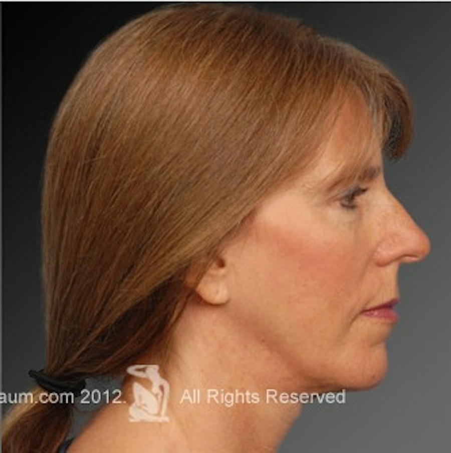 Patient 106009212 | Profile View | After | Face and Neck Lift — Steven Teitelbaum MD -