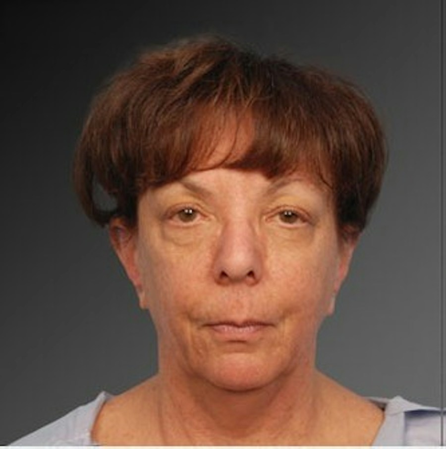 Patient 106009215 | Front View | Before | Face and Neck Lift — Steven Teitelbaum MD -