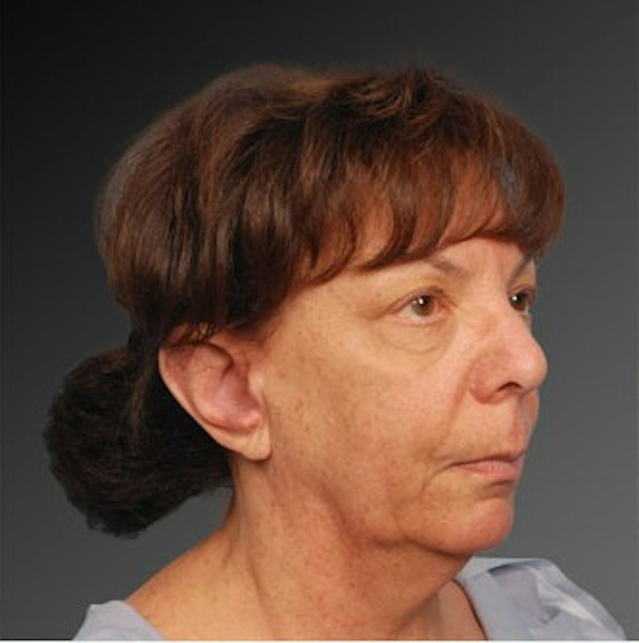 Patient 106009215 | Angle View | Before | Face and Neck Lift — Steven Teitelbaum MD -