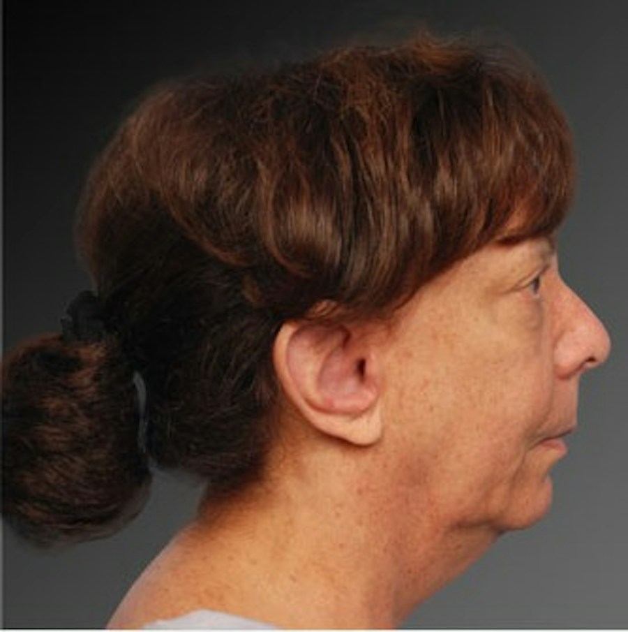 Patient 106009215 | Profile View | Before | Face and Neck Lift — Steven Teitelbaum MD -