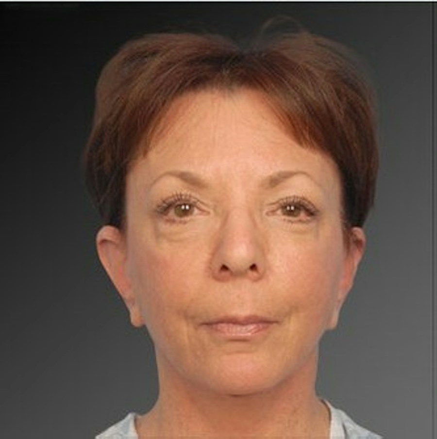 Patient 106009215 | Front View | After | Face and Neck Lift — Steven Teitelbaum MD -